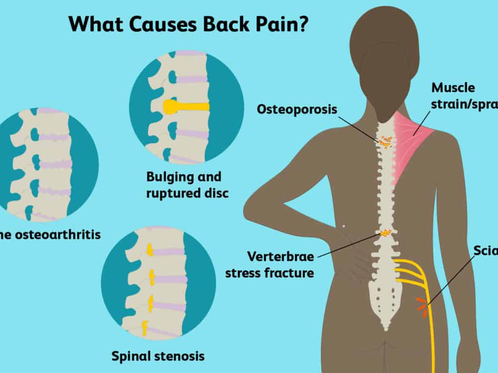 What-Causes-Back-Pain