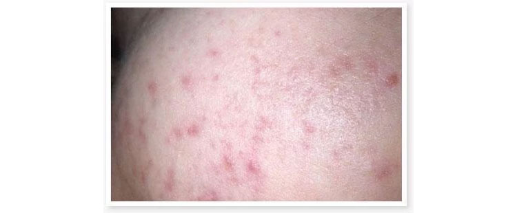 Post-Inflammatory-Erythema-(PIE)