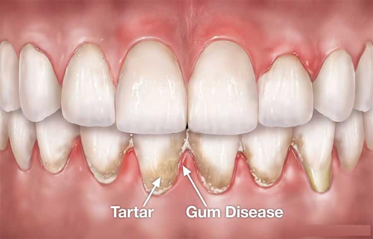 Gum-Disease