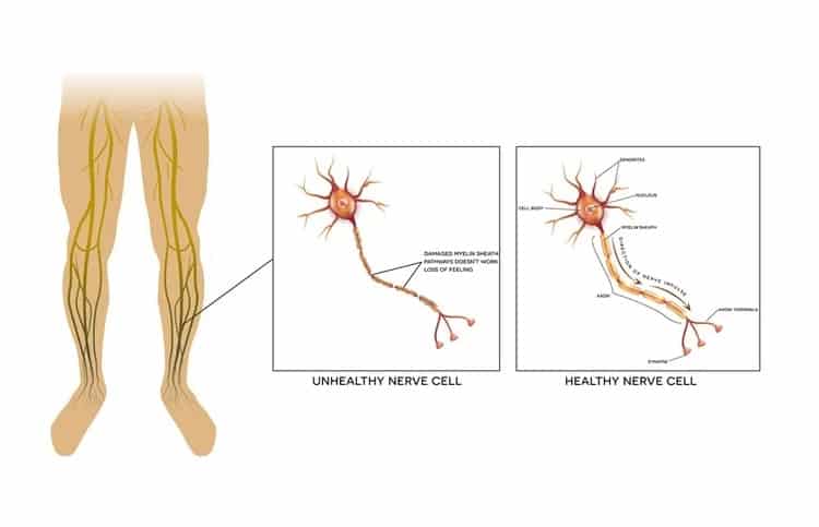 Healthy and Unhealthy Nerve Cell