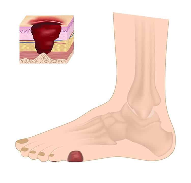 Improve neuropathy symptom